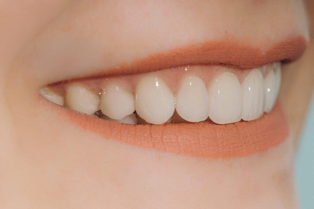 セラミックの歯の綺麗な歯並び