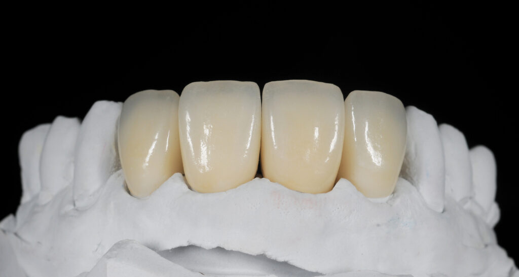 歯茎が黒くならないセラミックの素材のジルコニア