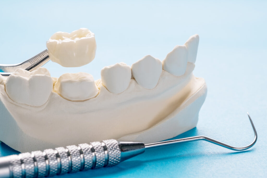 セラミックを被せられる歯の模型と歯科用器具