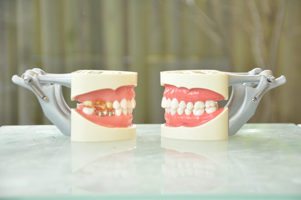 ラミネートベニアができない歯の模型